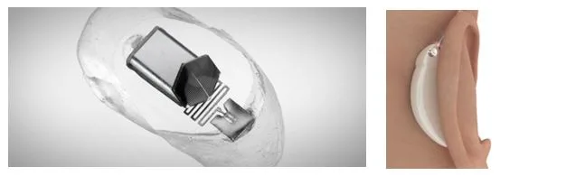 Application of rigid-flex PCB in hearing aids